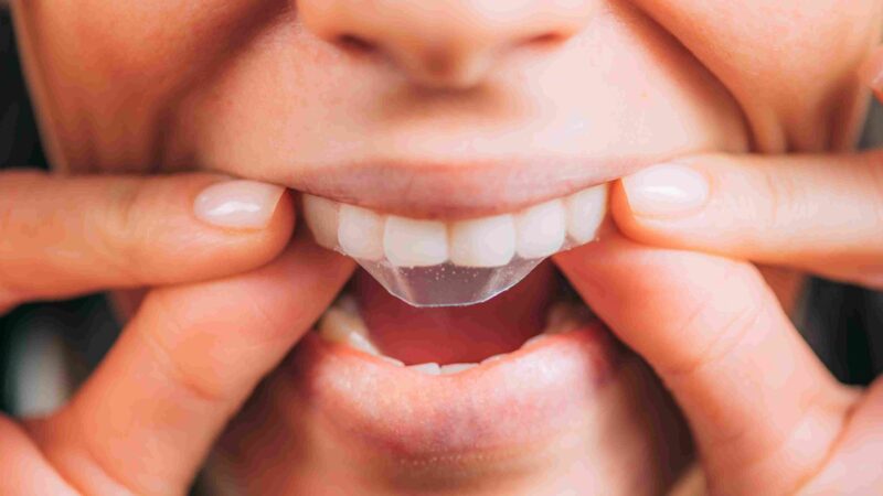 Person applying a teeth whitening strip to upper teeth