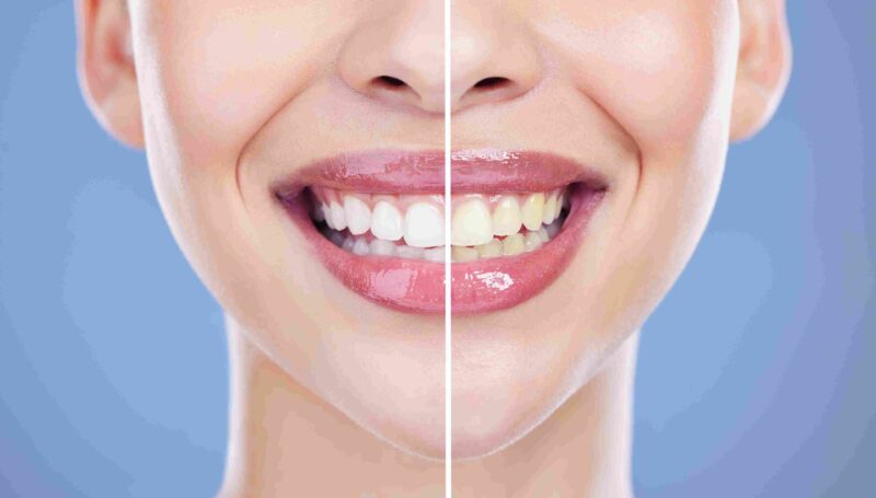 Close up of a smile split to show before and after teeth whitening