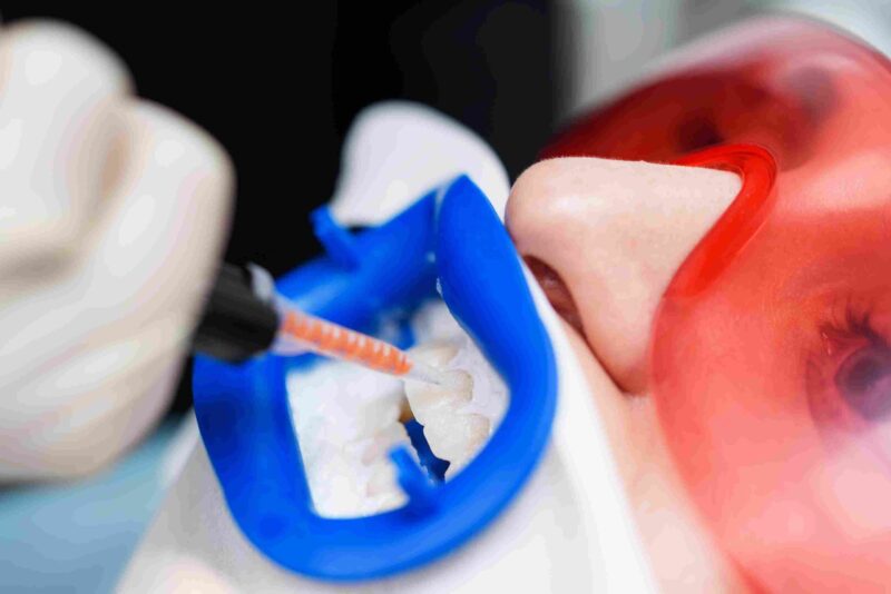 Close up of dental treatment with gel applied to teeth using a tray and tool